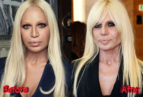 donatella cappello versace|donatella versace before and after surgery.